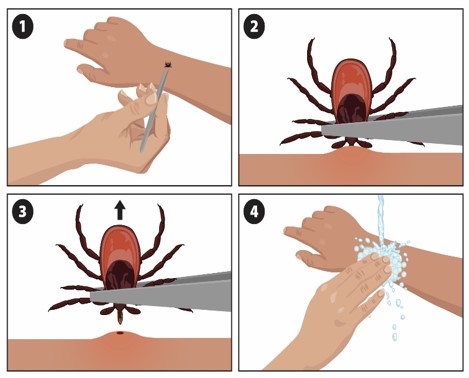 Illustration showing steps of tick removal: Use tweezers, pull upward, and clean the bite area after removal. source CDC