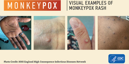 a variety of examples of monkeypox rashes